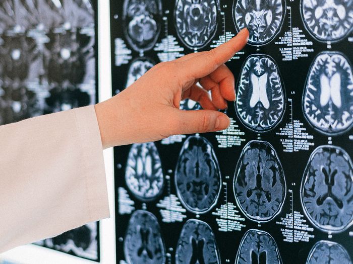 A doctor points at a series of brain MRI scans on a light board